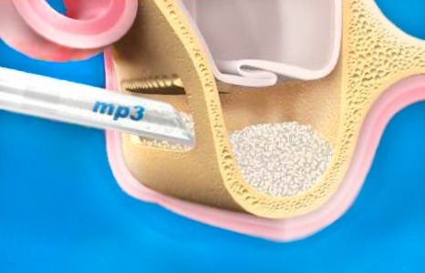Техника открытого синус-лифтинга с применением OsteoBiol® в стоматологии